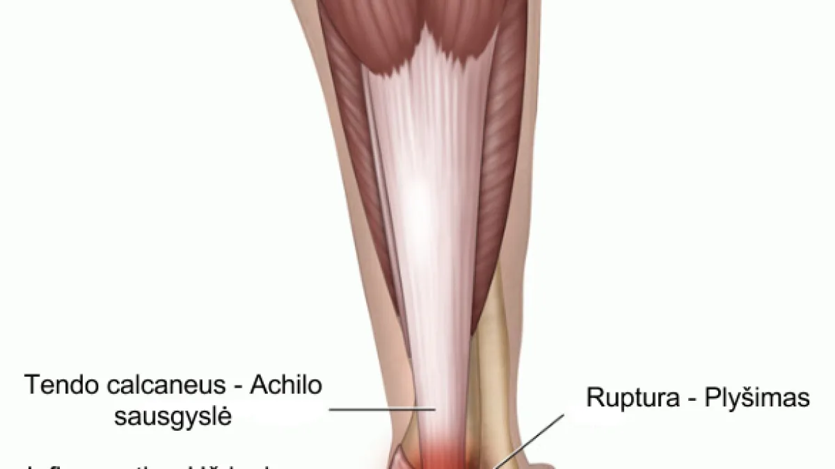 Vue de Tendon
